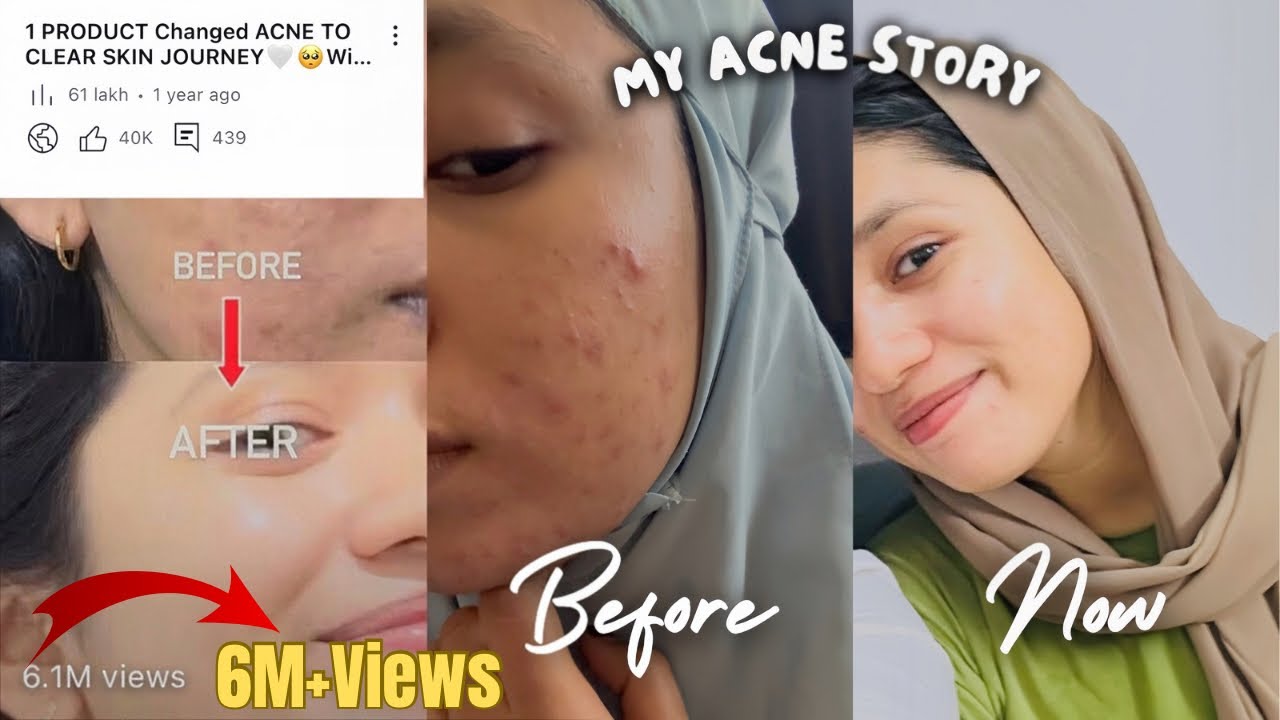 My Acne Recovery & you can too✅|Oily Skin,Failed Remedies|No Sponsorships❌Skincare|Malayalam.