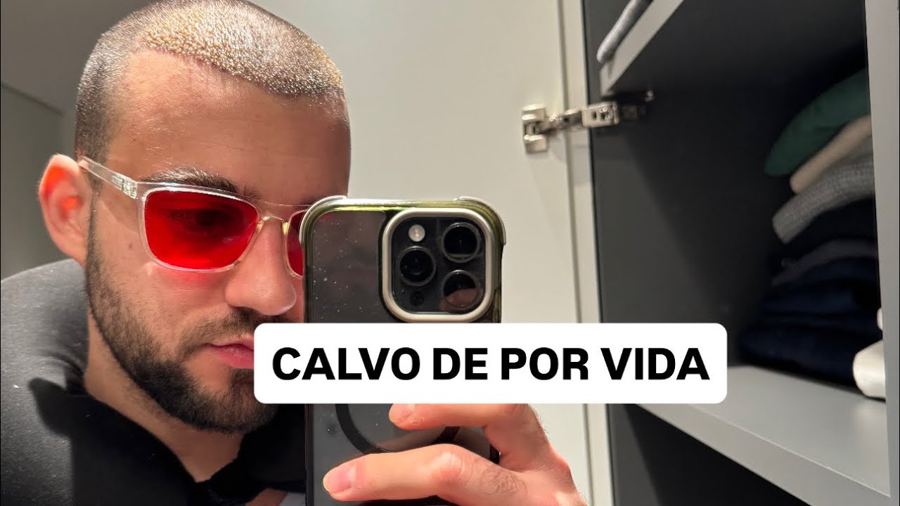 Hacerse un trasplante capilar no es tan sencillo