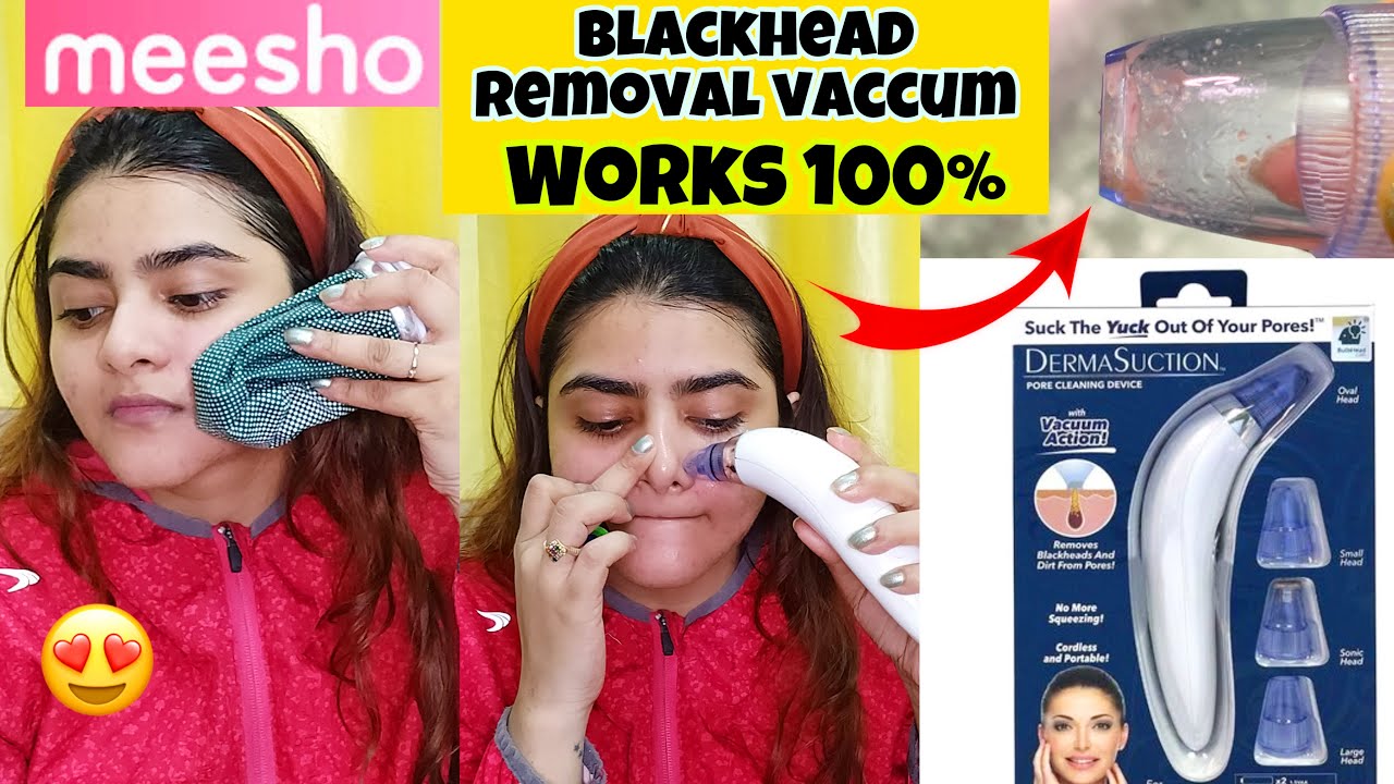 MEESHO Blackhead Remover Machine | How to remove BLACKHEADS | Works 100% | 