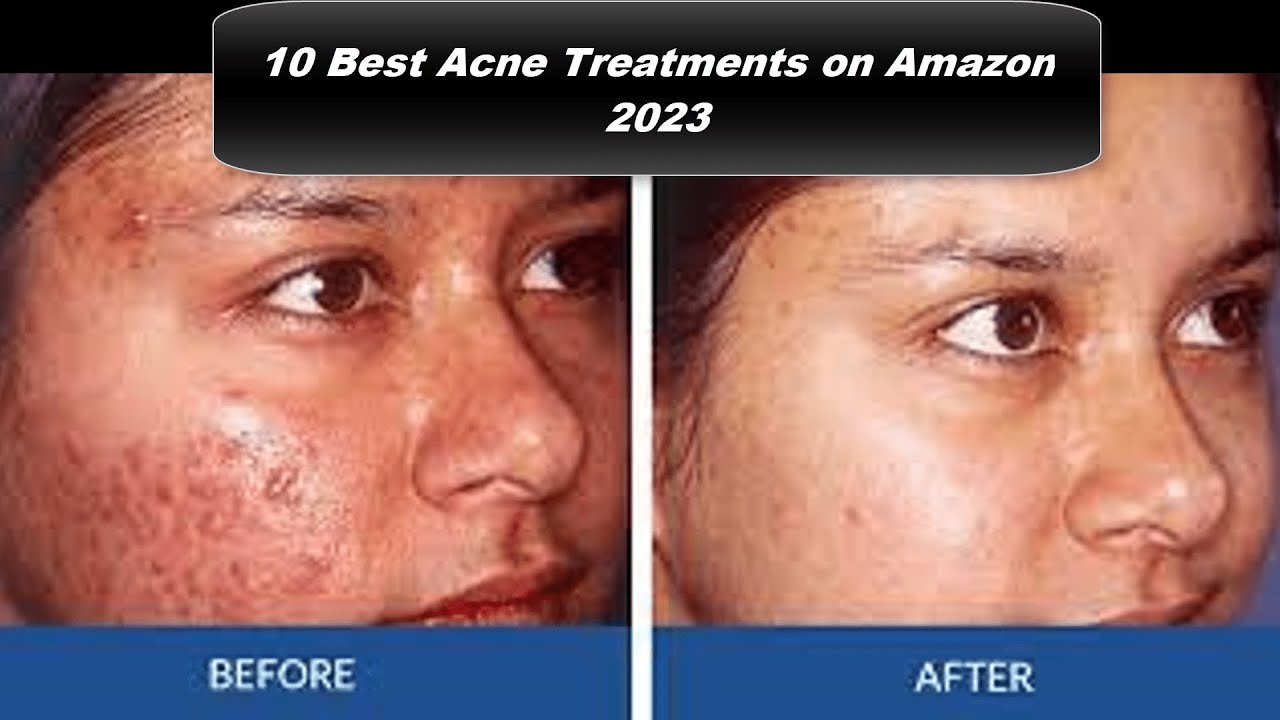10 Best acne treatment on amazon you should try 
