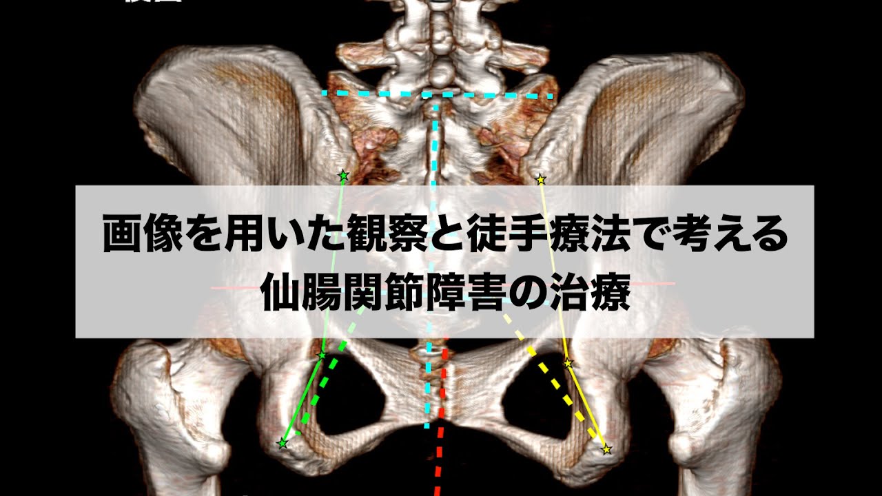 【仙腸関節障害の治療】画像を用いた観察と徒手療法で考える