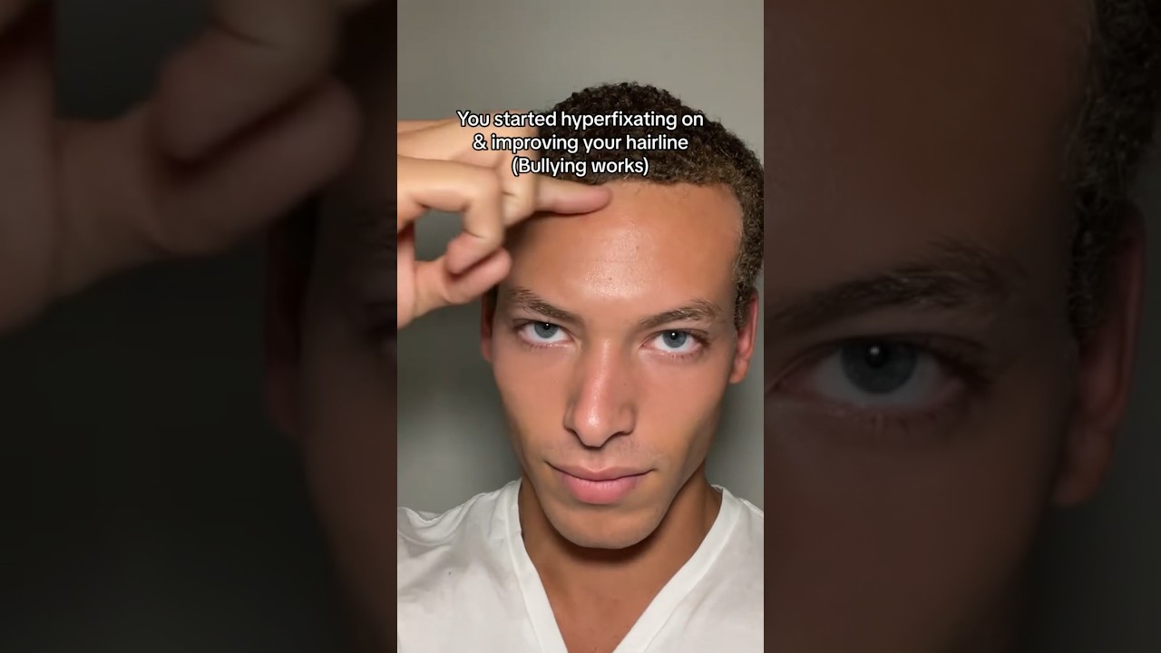 How to fix your hairline and reverse balding / thinning hair.