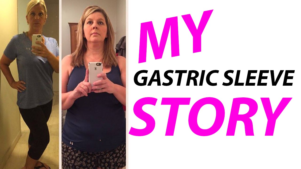 Kim - Gastric Sleeve Before and After Pictures | 2016