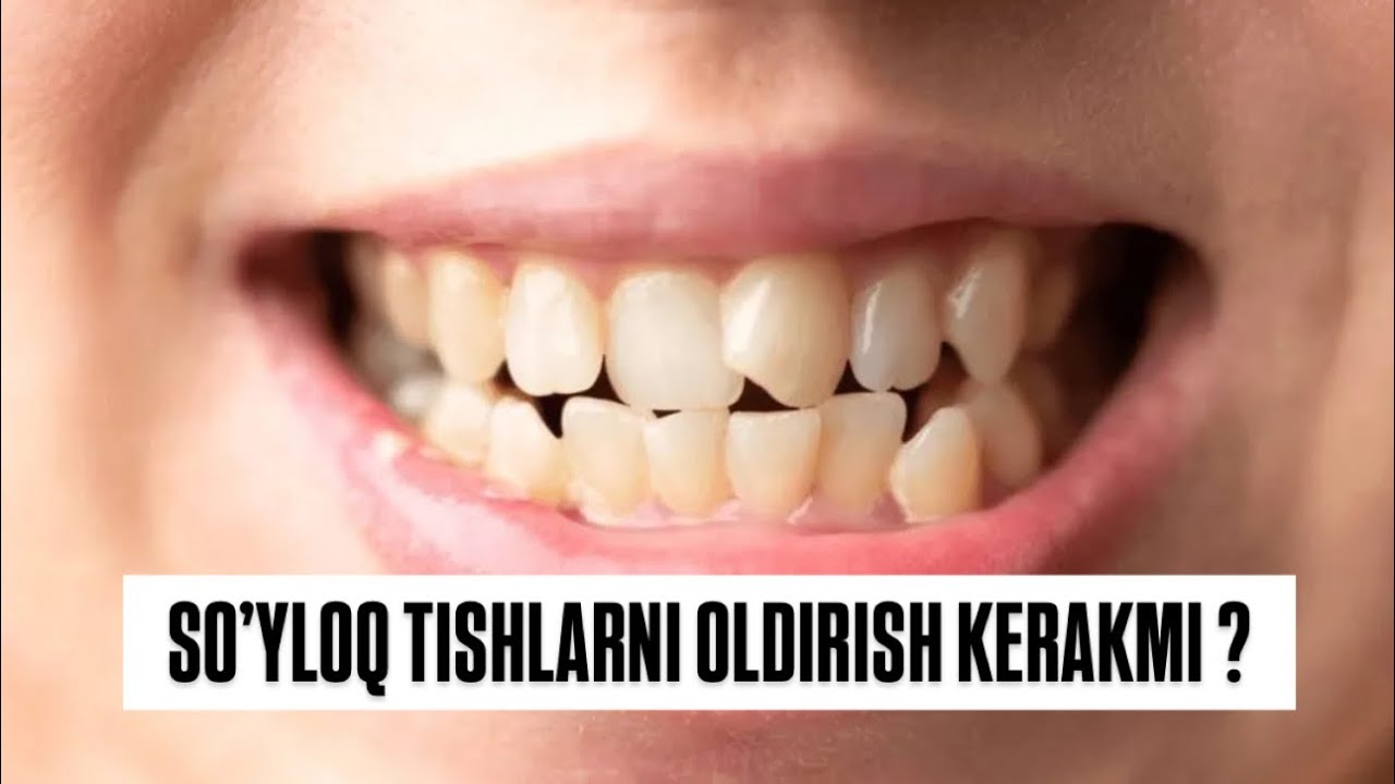 So’yloq tishlarni oldirish kerakmi ? #shifokor#dentist#rek#teeth#tish# so’yloq#stomatolog 