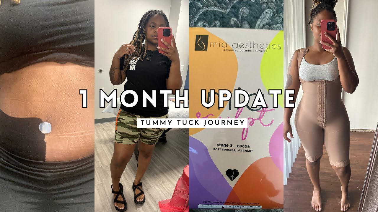1 MONTH UPDATE | TUMMY TUCK