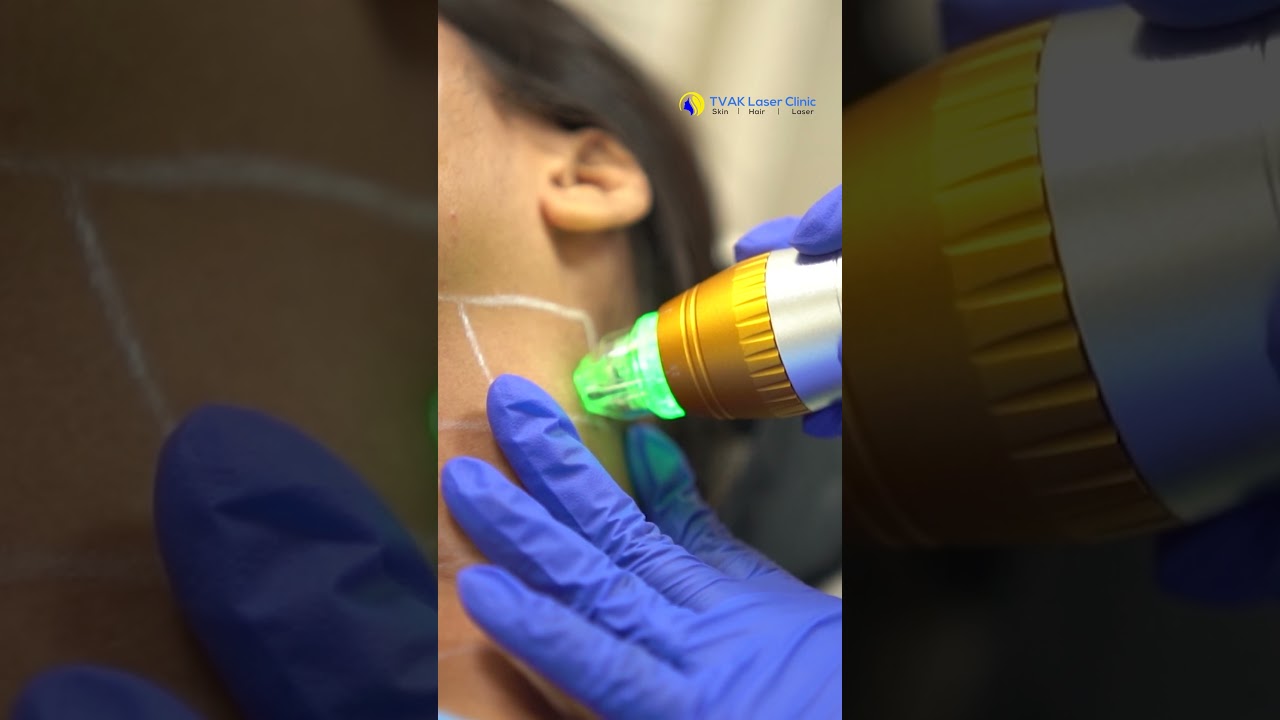Best Skin Tightening treatment | MNRF treatment | Best Dermatologist&nbsp;in&nbsp;Delhi | Dr. Jaishree