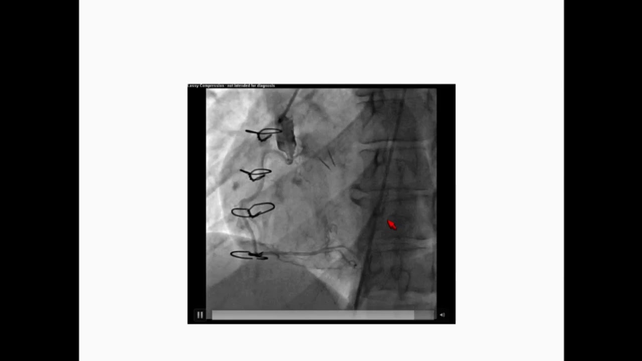 CVI2017 Challenging Case: My Institution's Interesting STEMI - Amir Solhpour, MD