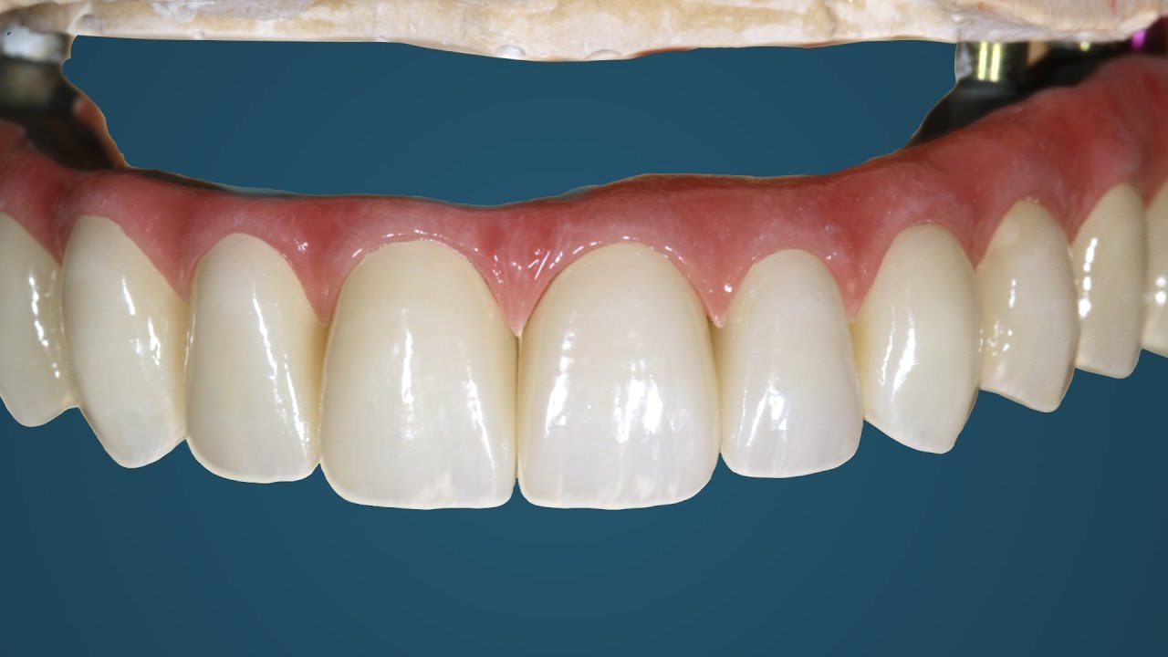 The Most Difficult Full Mouth Implant Case | Part 2