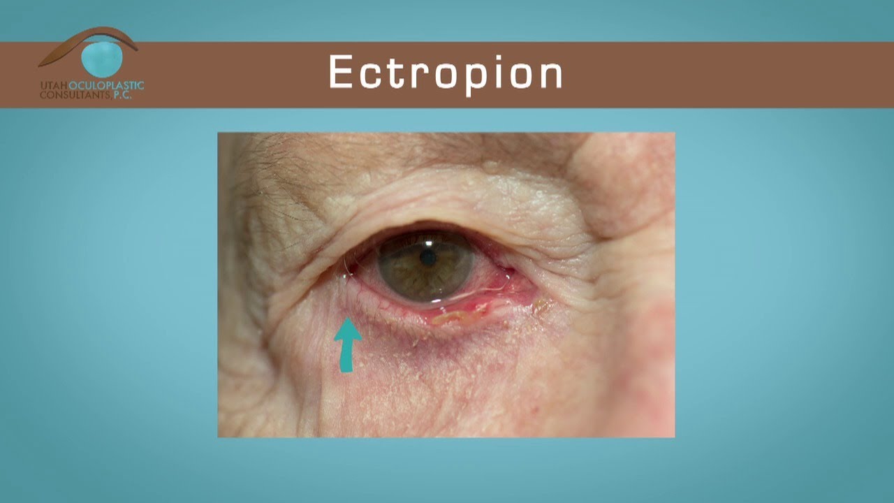 Entropion and Ectropion