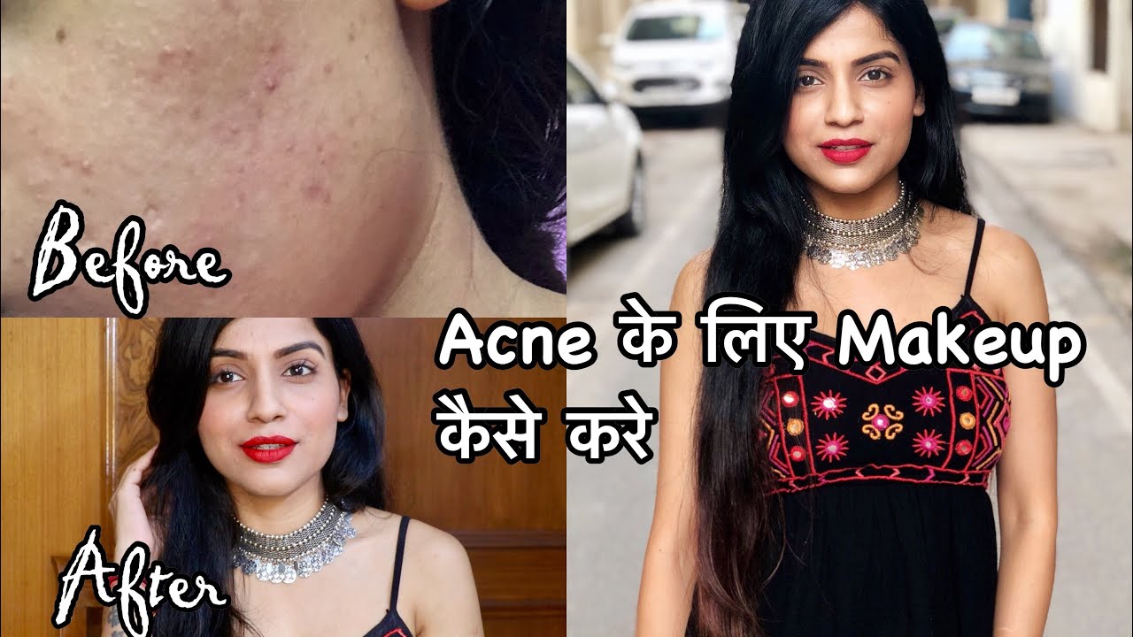 MAKEUP TUTORIAL FOR ACNE PRONE SKIN | How To Hide Acne & Pigmentation With Makeup | Nidhi Chaudhary