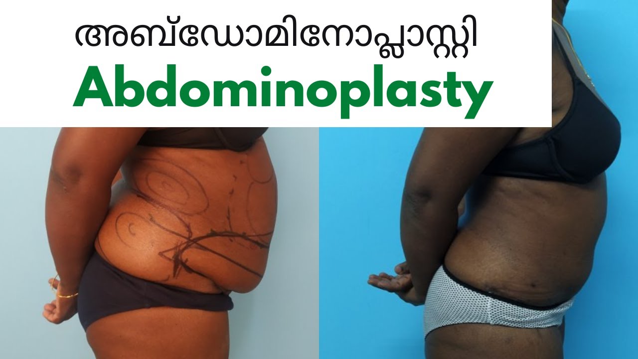 Abdominoplasty | അബ്‌ഡോമിനോപ്ലാസ്റ്റി I Malayalam