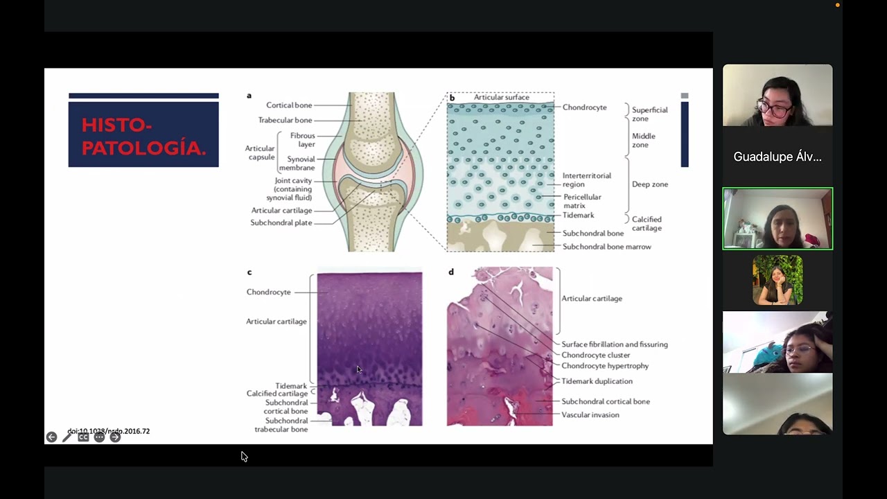Osteoartritis