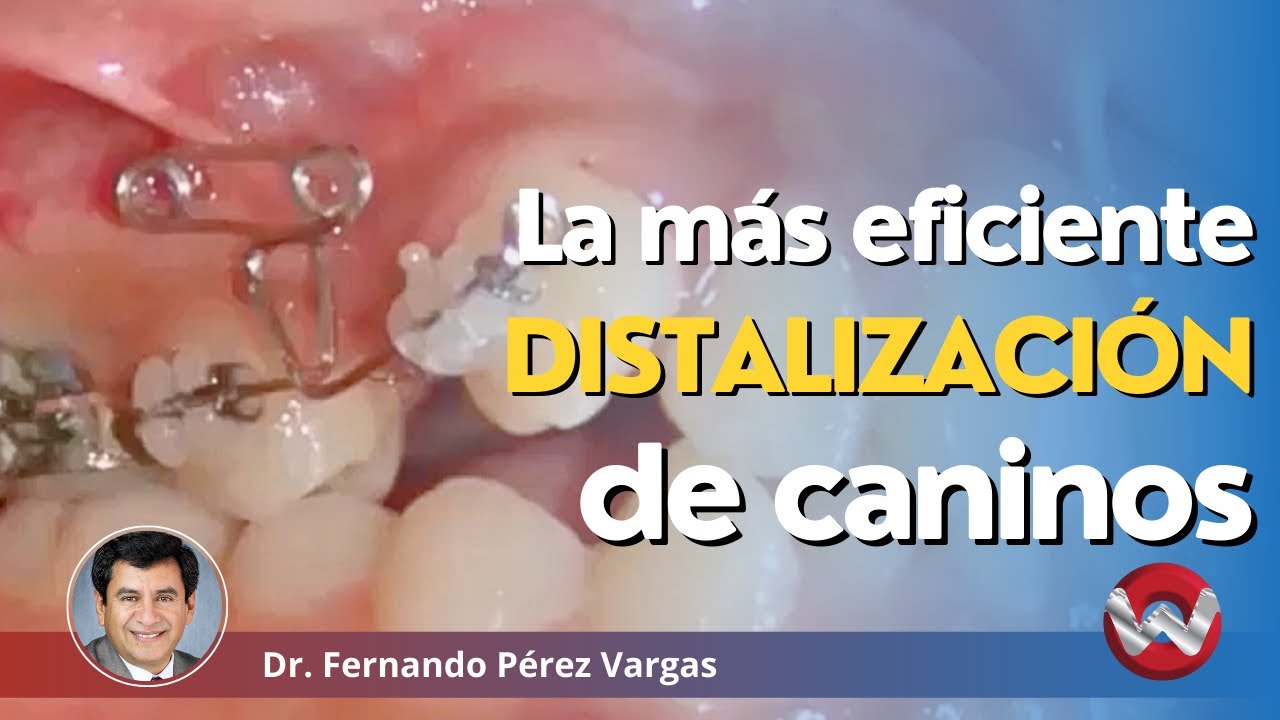La manera mas eficiente de distalizar caninos en apiñamiento severo
