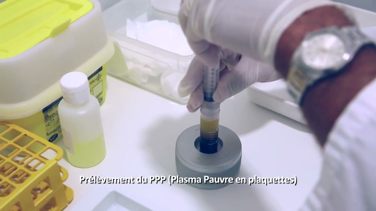 Traitement des tendinopathies fissuraires par injection de PRP