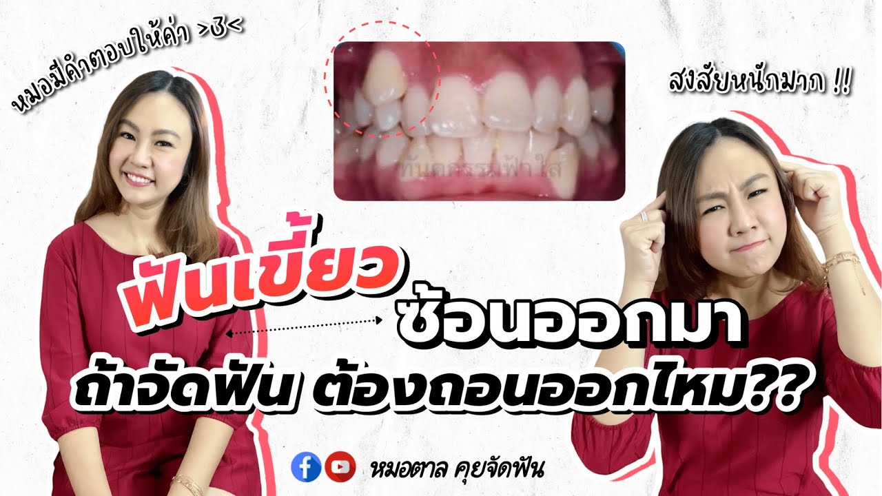 ฟันเขี้ยวซ้อนออกมา จัดฟันต้องถอนฟันเขี้ยวไหม? | หมอตาล จัดฟันระยอง ทันตกรรมฟ้าใส