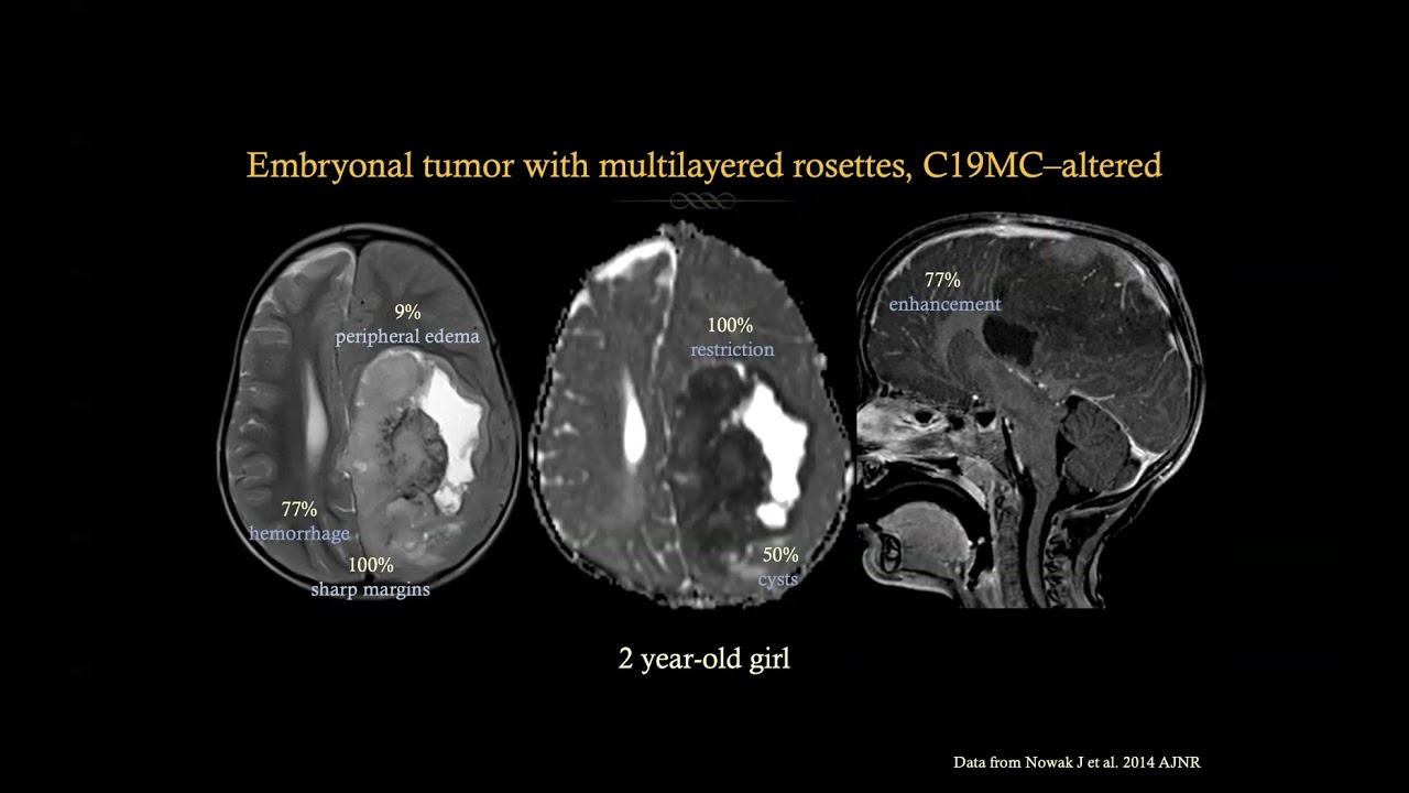 Pediatric Neuro-oncology Tricky Cases - What I have learned from my mistakes