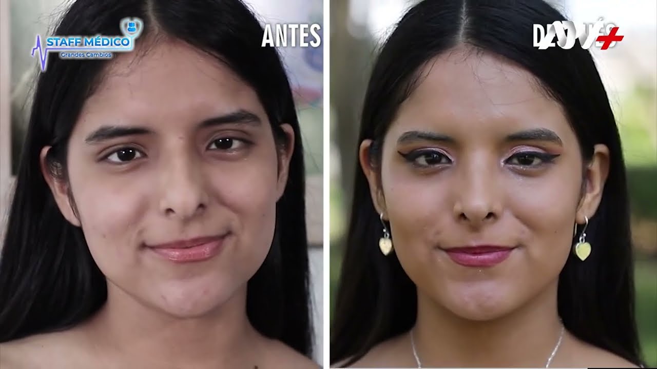 💯Resultados excelentes de SEPTORINOPLASTIA L&Aacute;SER- Dr. Iv&aacute;n Guanilo, cirujano pl&aacute;stico.👨🏻&zwj;⚕️