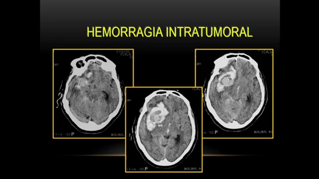 Diagnóstico por imágenes en Sistema Nervioso Central  - UNR FCM