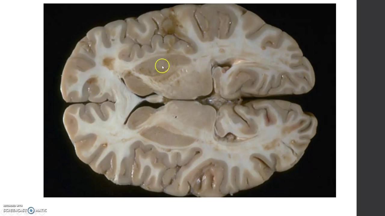 Anatomía interna de los hemisferios: ubicación de las estructuras subcorticales.