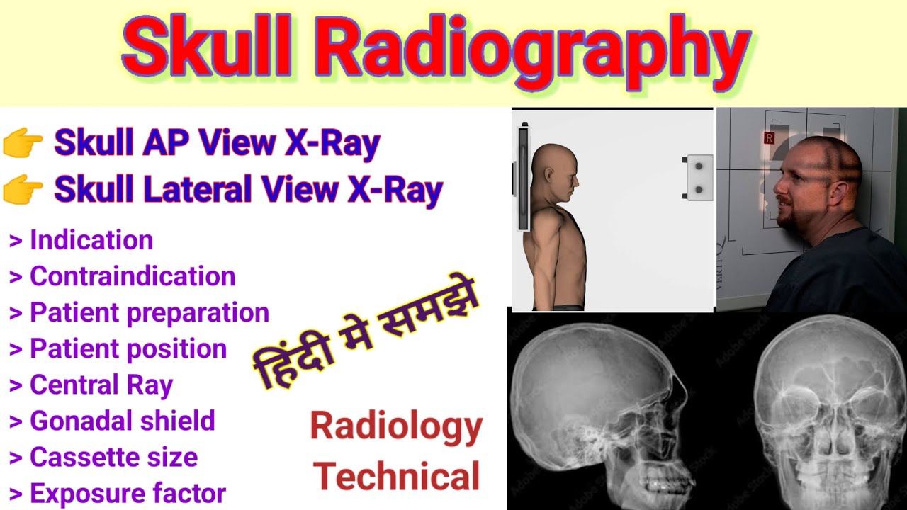 Skull Radiography # Skull AP view & Skull lateral view x-ray # Patient position # In hindi #