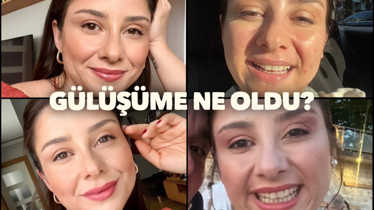 Masseter Botoks - Bu Videoyu İzlemeden Yaptırmayın!! 😱