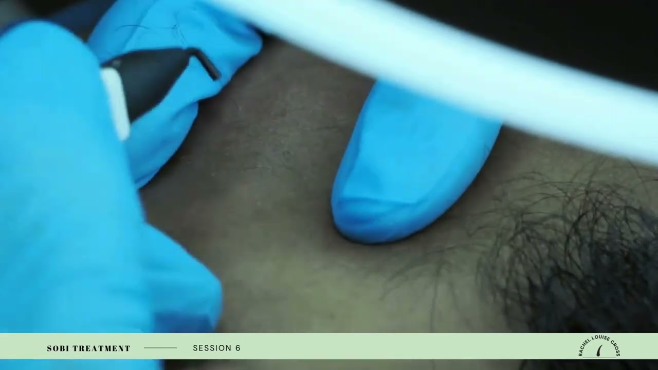 Dr Sobi Electrolysis Journey - Session 6