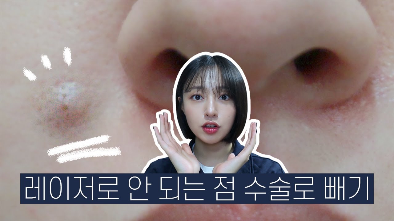 빼도 빼도 튀어나오는 돌출점🤦🏻&zwj;♀ 제거 수술로 뺀 후기 | 10달 차 후기