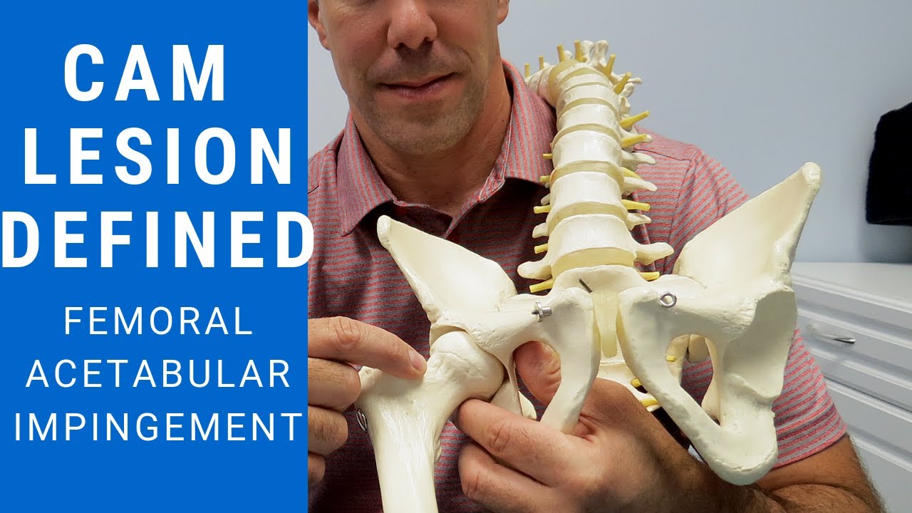 CAM Lesions Explained