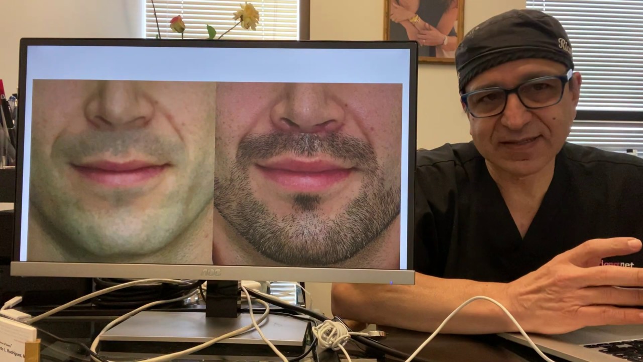 Lip Lifts for Men