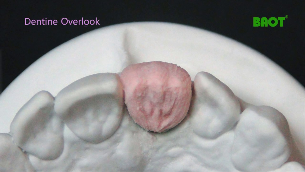 BAOT DENTAL CERAMICS INSTRUCTION VIDEO FOR PFM