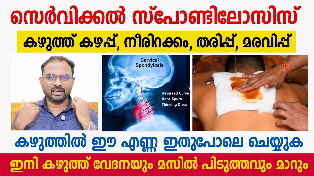 കഴുത്ത് വേദന ( Cervical Spondylosis ) മാറാൻ ഇങ്ങനെ ചെയ്യുക | Neck pain treatment | DrVisakh Kadakkal