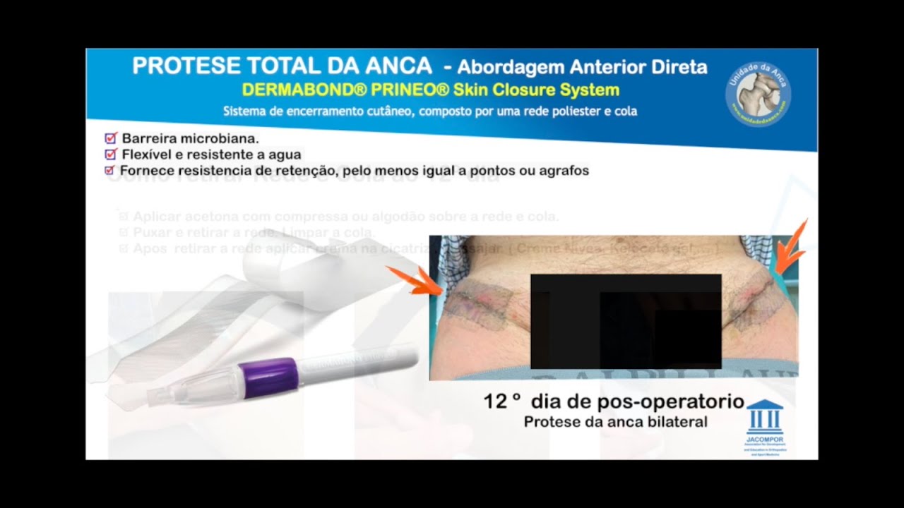 Dermabond, penso na protese da anca