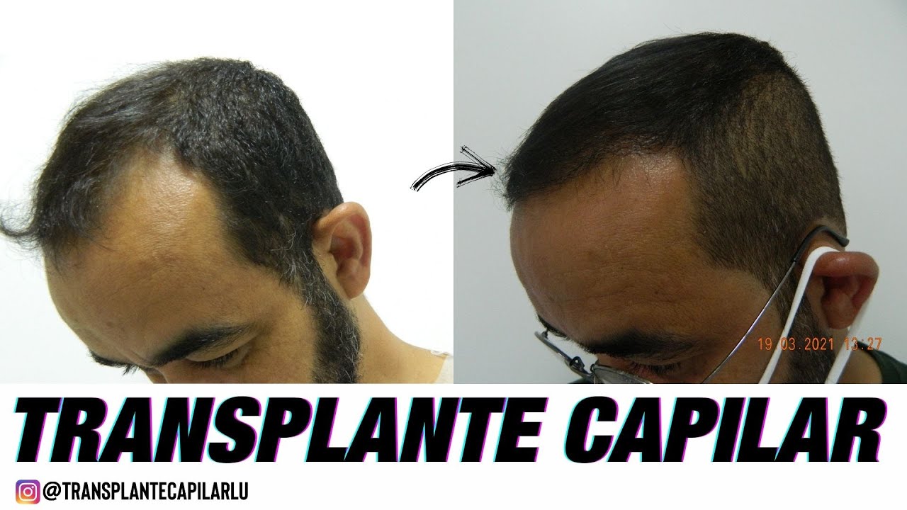 Resultado real Pós transplante capilar 4 meses Dr. Paulo Lu 40% resultado Importante mostrar durante