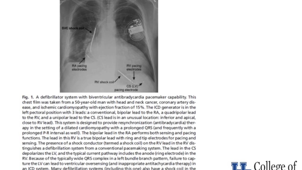 Basic Management of Perioperative Pacemakers  - Dr. Murphy