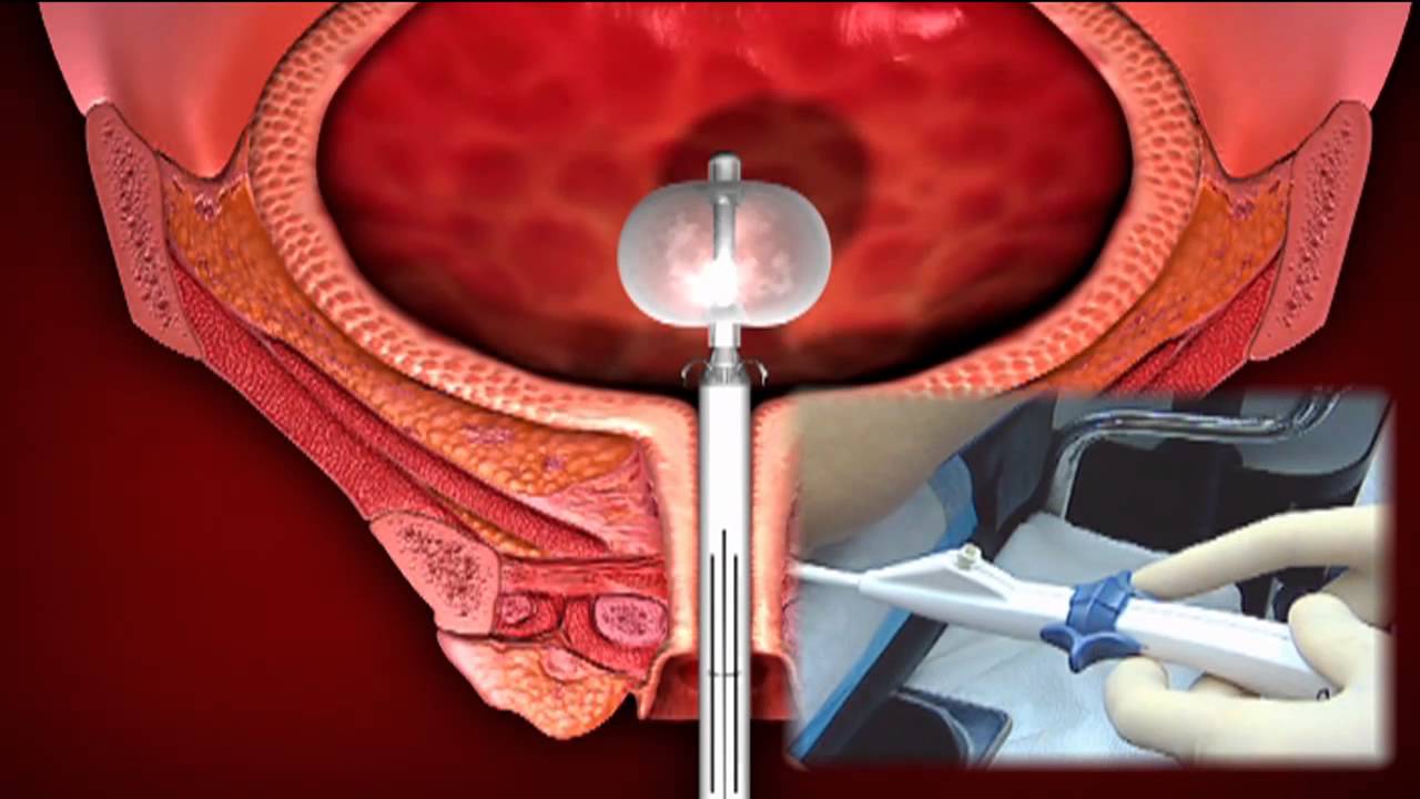 Treating Stress Incontinence Without Surgery