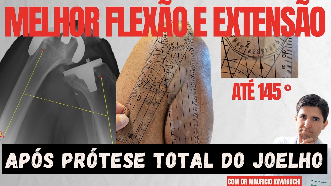 Como ter maior FLEXÃO E EXTENSÃO após Prótese Total do Joelho (Com Exercícios Demonstrativos!)