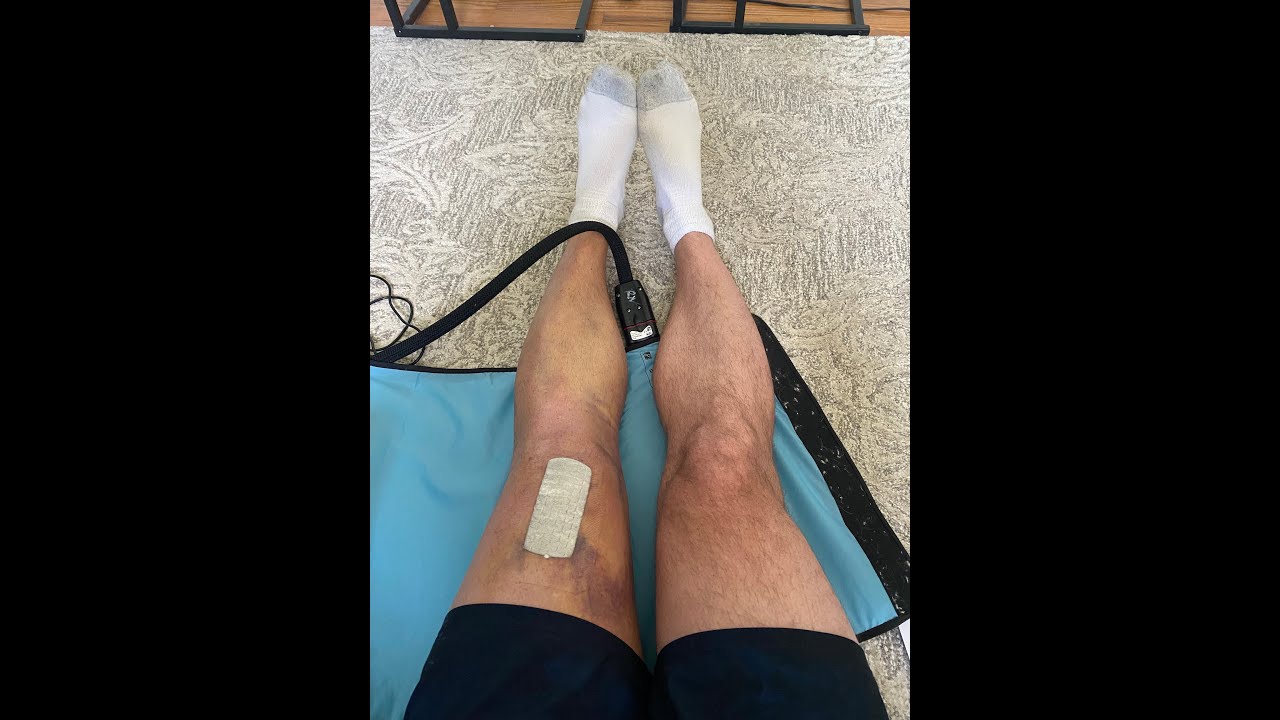 Quadriceps Tendon Repair Surgery - Week 0