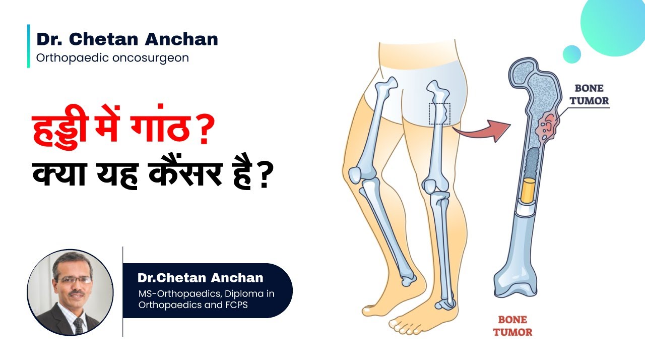 हड्डी में गांठ ? क्या यह कैंसर है ? | Are all bone tumors cancerous? |  Dr  Chetan Anchan
