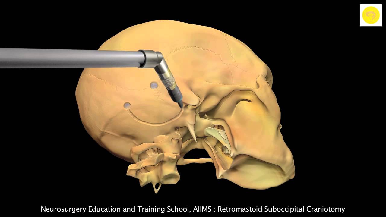 Neurosurgery 3D Animation Video : Retromastoid Suboccipital Craniotomy