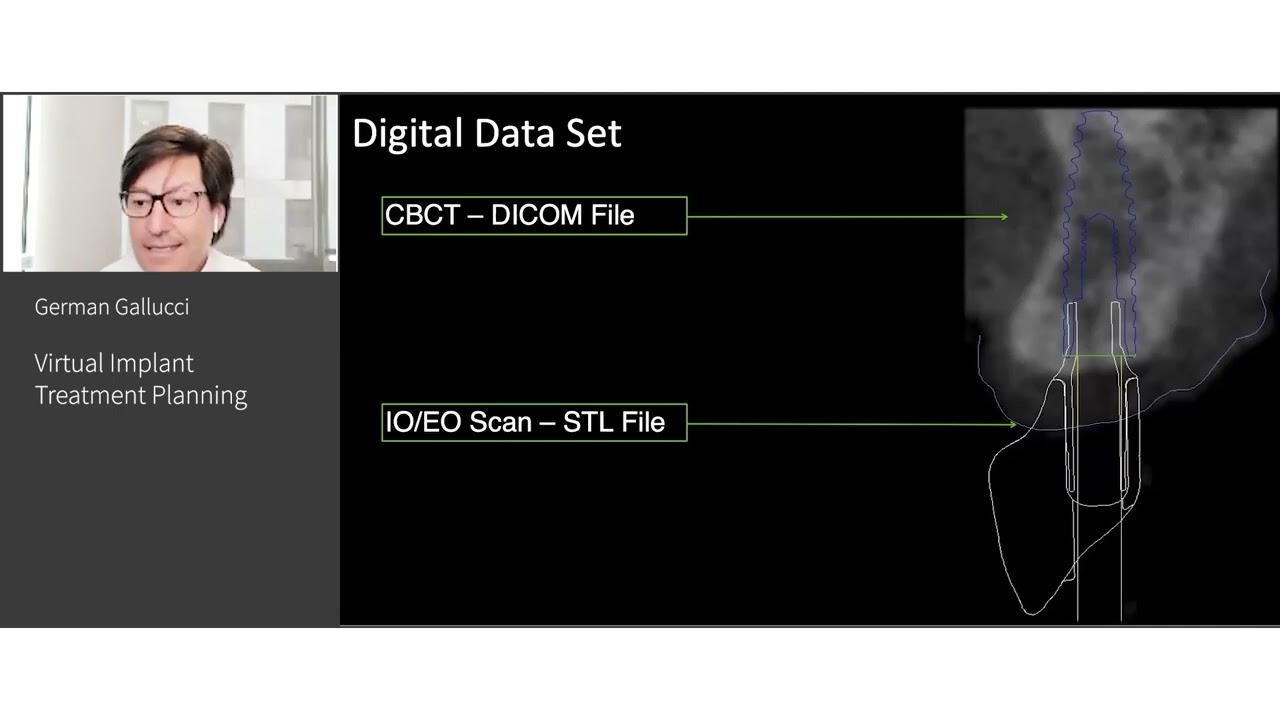Virtual Implant Treatment Planning | German Gallucci