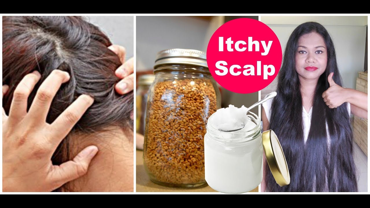 Get Rid Of ITCHY Scalp Fast | Best Tips & Home Remedies | Sushmita's Diaries