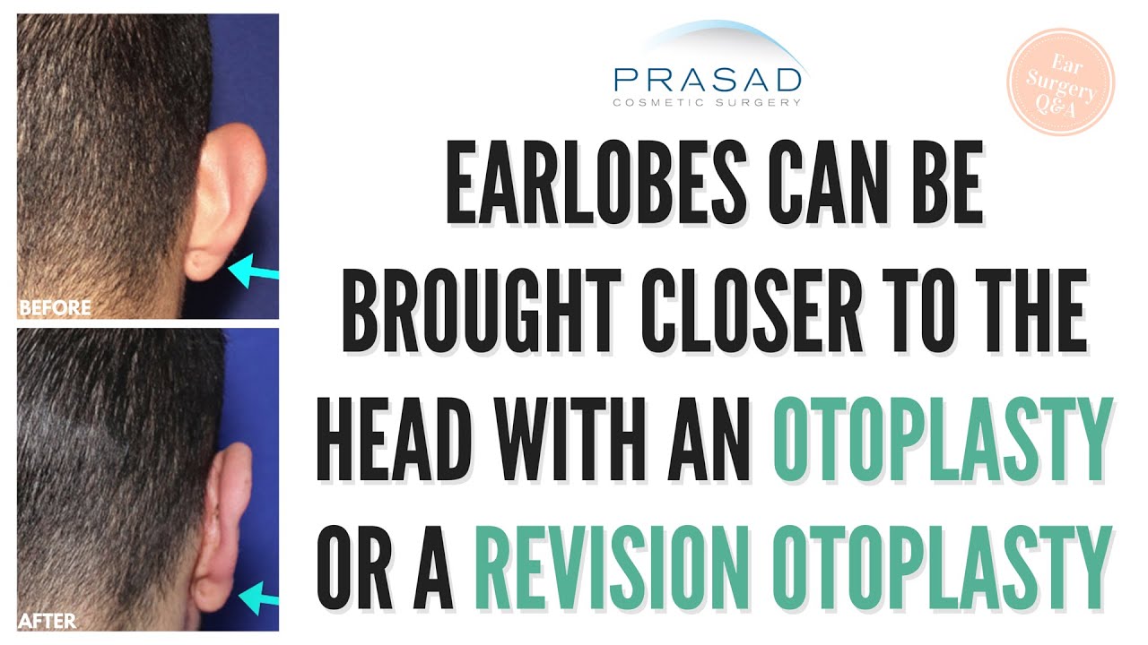 Earlobes can be Brought Closer to the Head, Even After Previous Ear Surgery (Otoplasty)