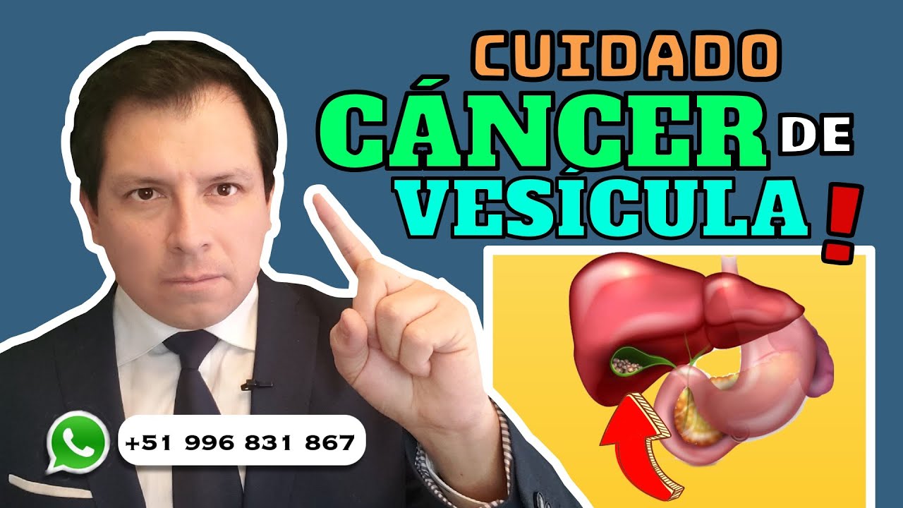 ALERTA ⚠️ PIEDRAS EN LA VESÍCULA RIESGO DE CÁNCER !!!