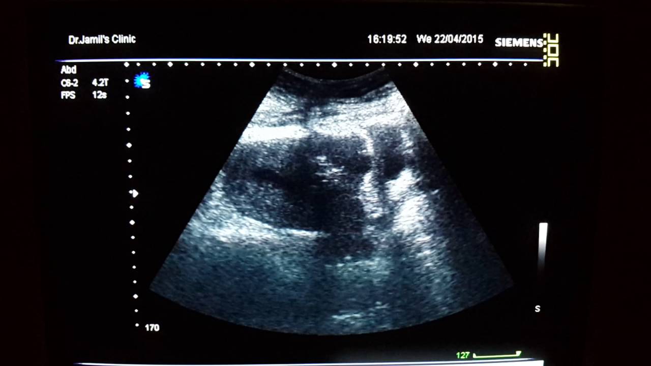 bladder flap hematoma