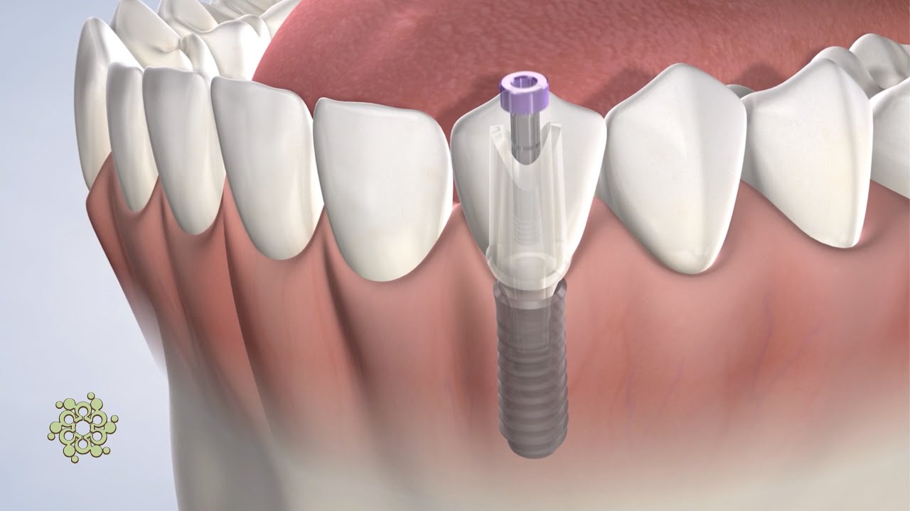 Post-Operative Instructions: Dental Implants | Gresham OR | Beacon Oral & Maxillofacial Surgeons