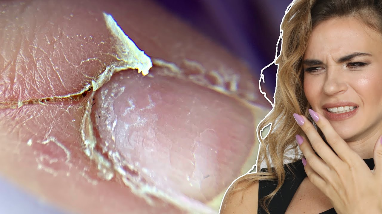 Bitten Nails & Sliced Cuticle Transformation