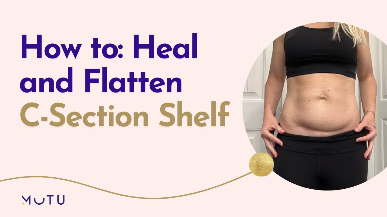 Why Your C-Section Shelf Won't Go Away and What to Do About it?
