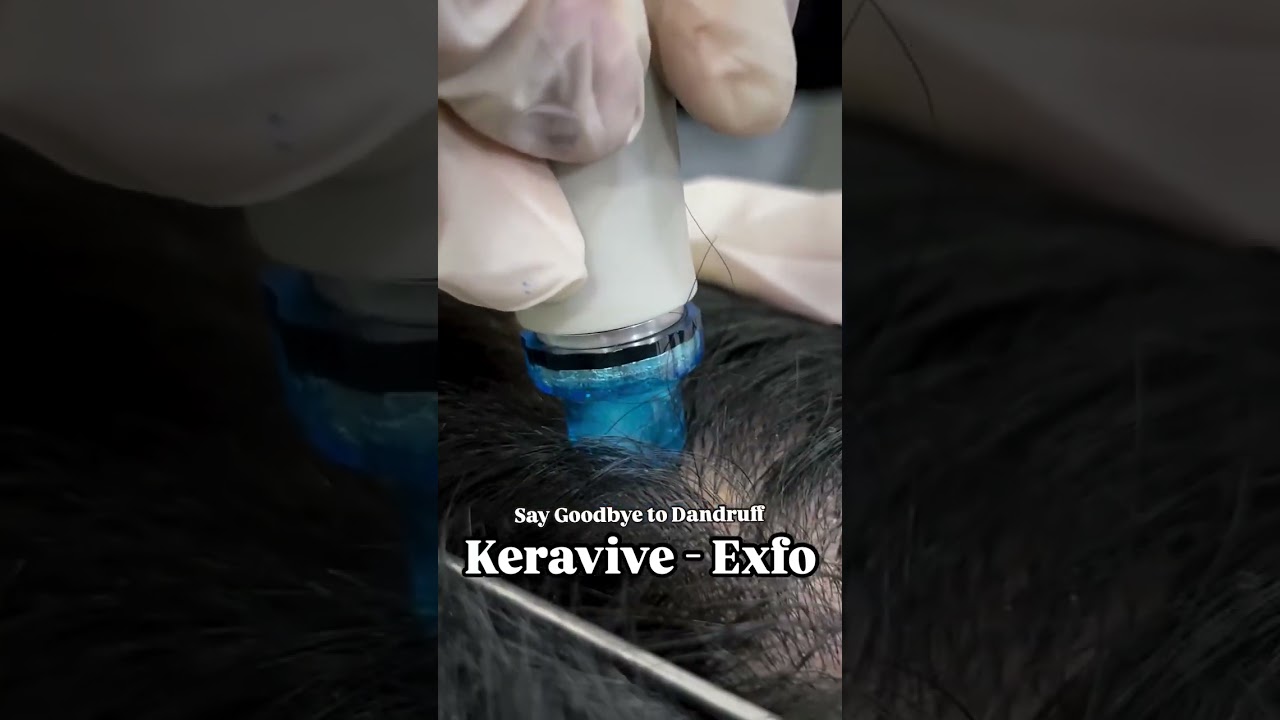 Keravive Exfo: Scalp Detox for Fuller, Healthier Hair!
