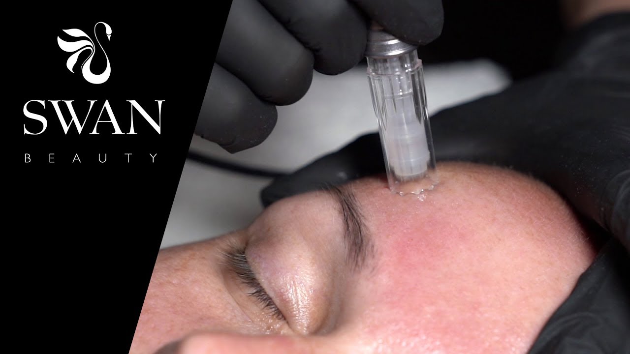 Microneedling Behandlung