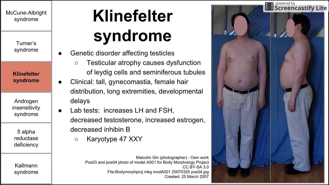 Disorders of sexual development
